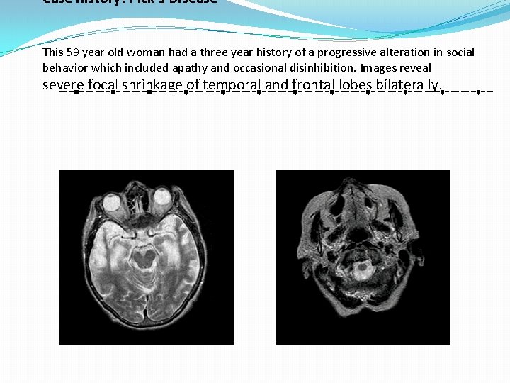 Case history: Pick's Disease This 59 year old woman had a three year history