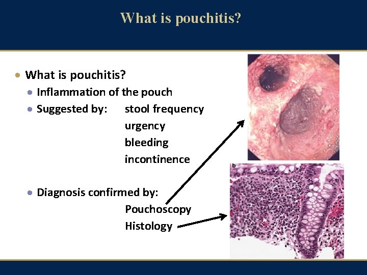 What is pouchitis? · What is pouchitis? · Inflammation of the pouch · Suggested