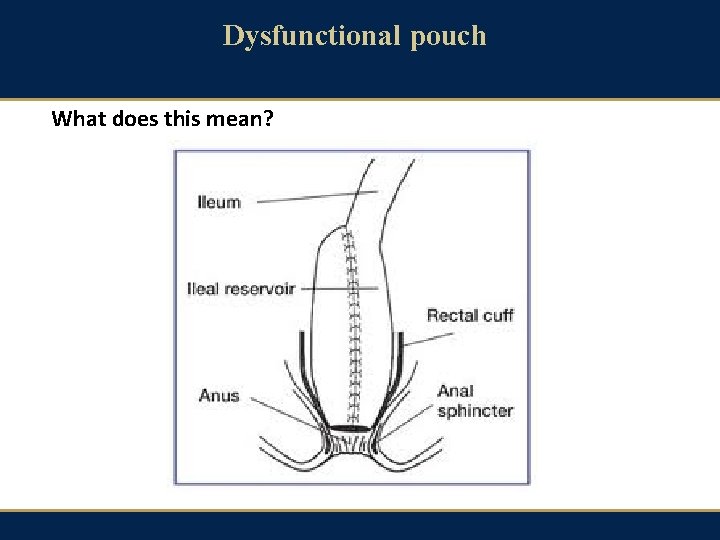 Dysfunctional pouch What does this mean? 