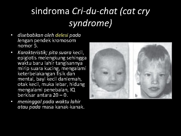 sindroma Cri-du-chat (cat cry syndrome) • disebabkan oleh delesi pada lengan pendek kromosom nomor