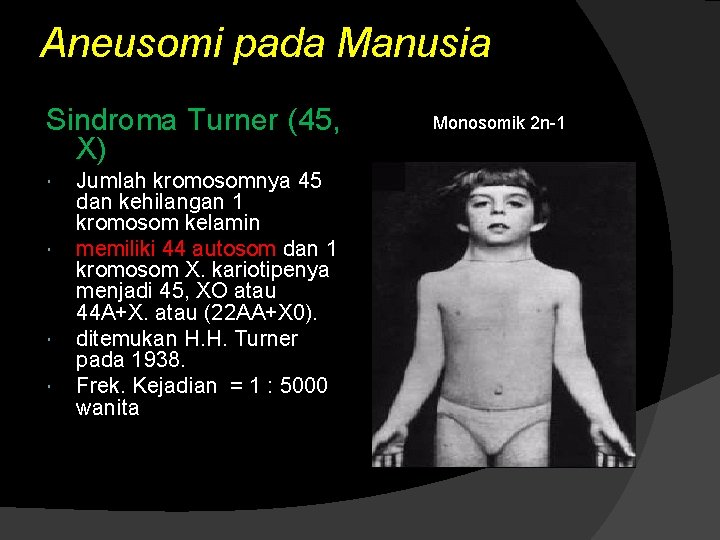 Aneusomi pada Manusia Sindroma Turner (45, X) Jumlah kromosomnya 45 dan kehilangan 1 kromosom