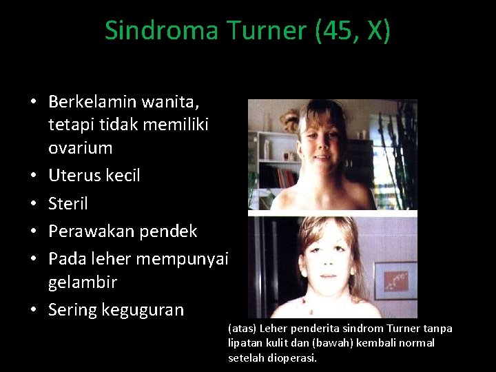 Sindroma Turner (45, X) • Berkelamin wanita, tetapi tidak memiliki ovarium • Uterus kecil