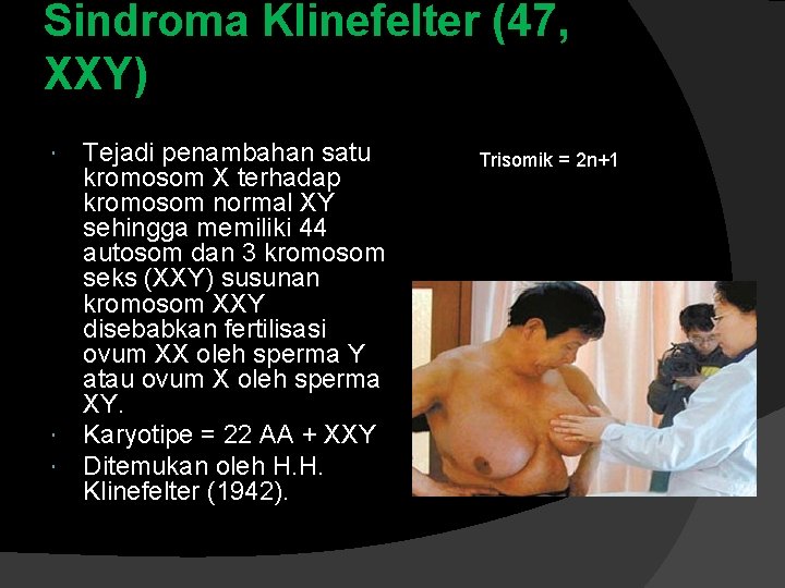 Sindroma Klinefelter (47, XXY) Tejadi penambahan satu kromosom X terhadap kromosom normal XY sehingga