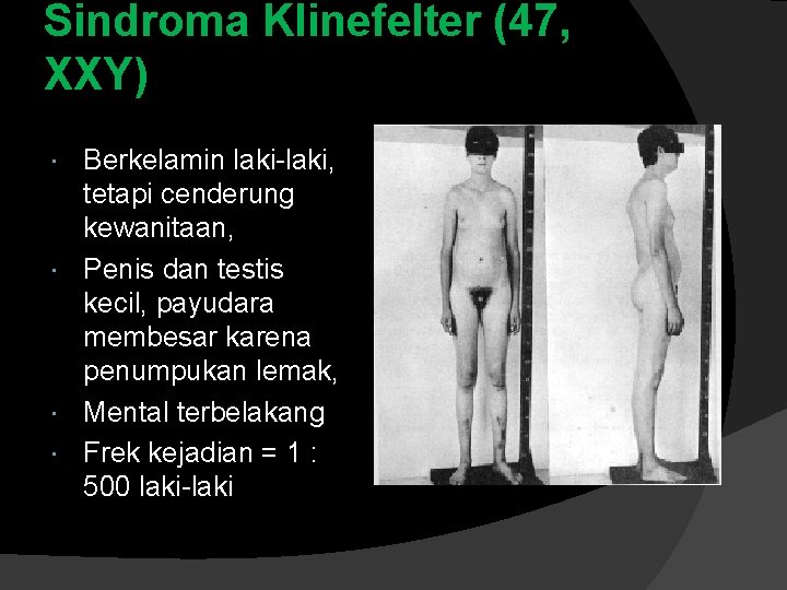 Sindroma Klinefelter (47, XXY) Berkelamin laki-laki, tetapi cenderung kewanitaan, Penis dan testis kecil, payudara
