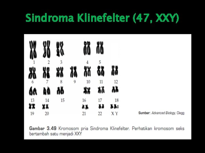 Sindroma Klinefelter (47, XXY) 