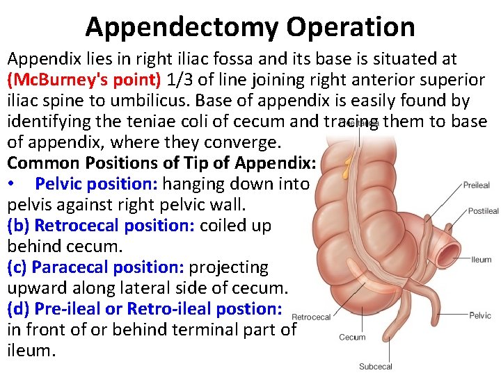 Appendectomy Operation Appendix lies in right iliac fossa and its base is situated at