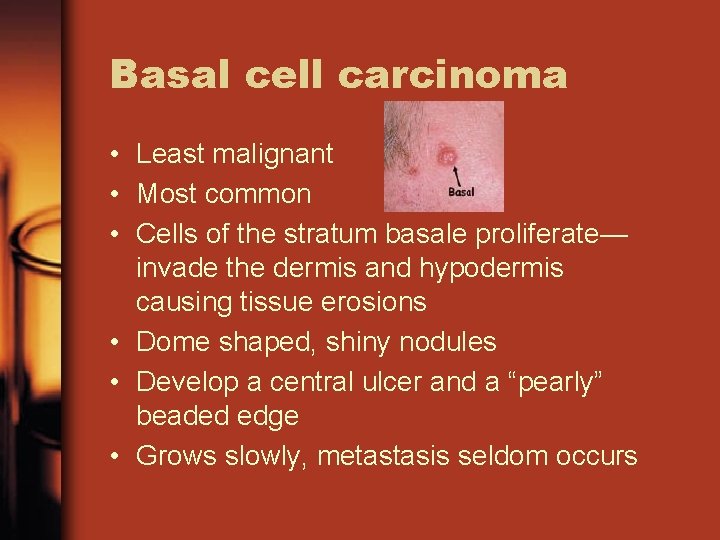 Basal cell carcinoma • Least malignant • Most common • Cells of the stratum