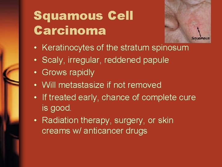 Squamous Cell Carcinoma • • • Keratinocytes of the stratum spinosum Scaly, irregular, reddened