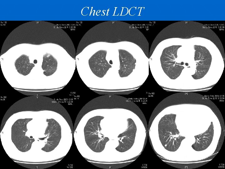 Chest LDCT 