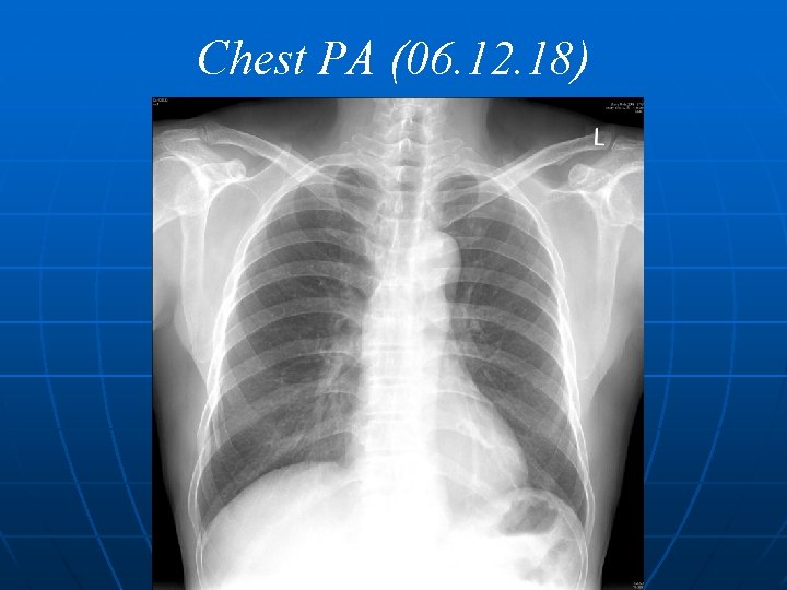 Chest PA (06. 12. 18) 