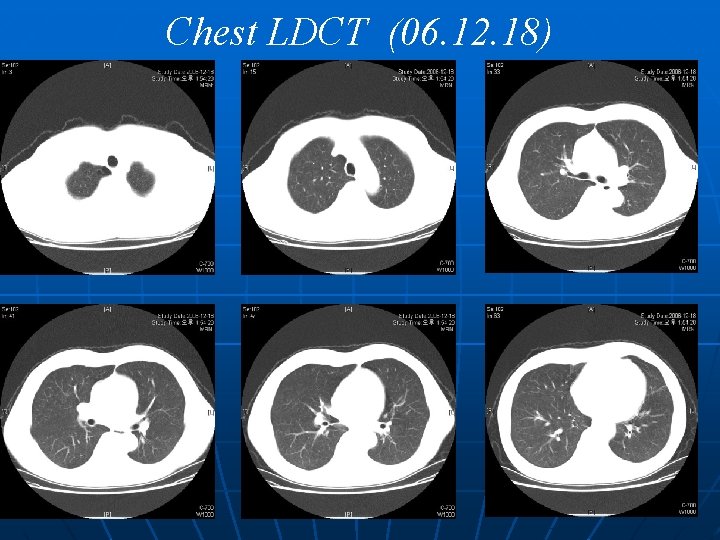 Chest LDCT (06. 12. 18) 