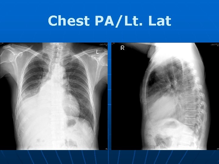 Chest PA/Lt. Lat 