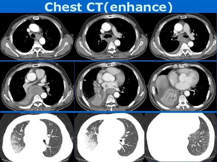 Chest CT(enhance) 