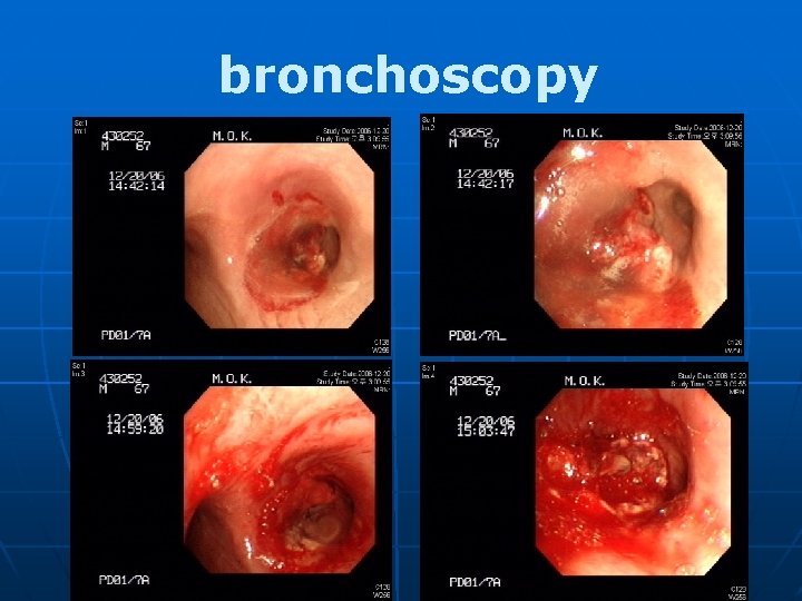 bronchoscopy 