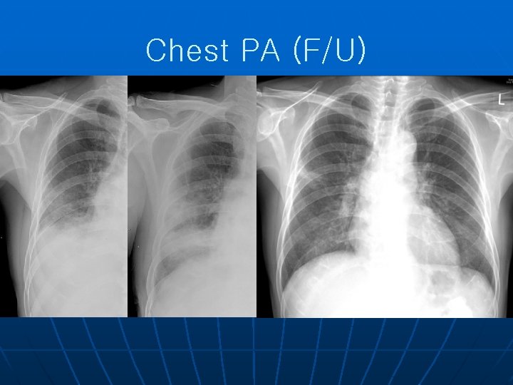 Chest PA (F/U) 