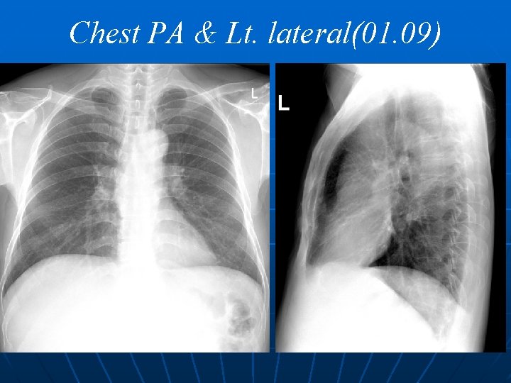 Chest PA & Lt. lateral(01. 09) 