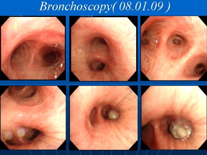 Bronchoscopy( 08. 01. 09 ) 