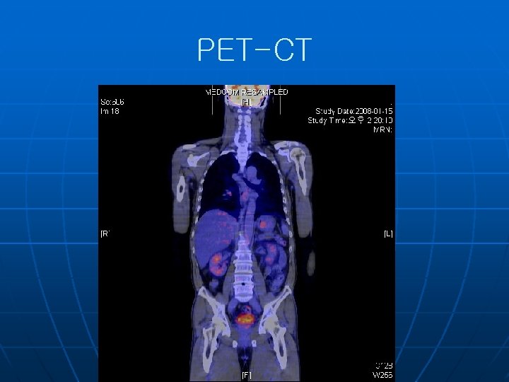 PET-CT 