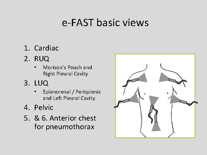 e-FAST basic views 1. Cardiac 2. RUQ • Morison’s Pouch and Right Pleural Cavity