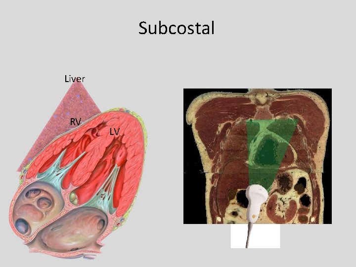 Subcostal Liver RV LV 