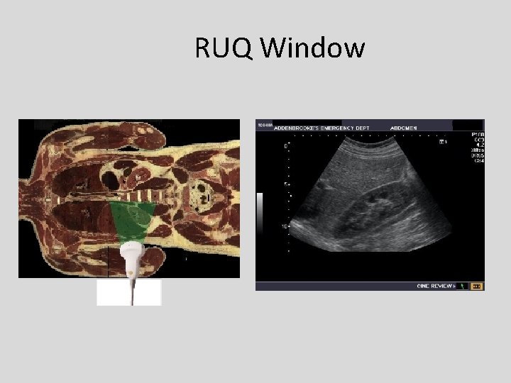 RUQ Window 