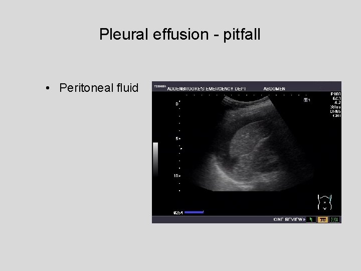 Pleural effusion - pitfall • Peritoneal fluid 