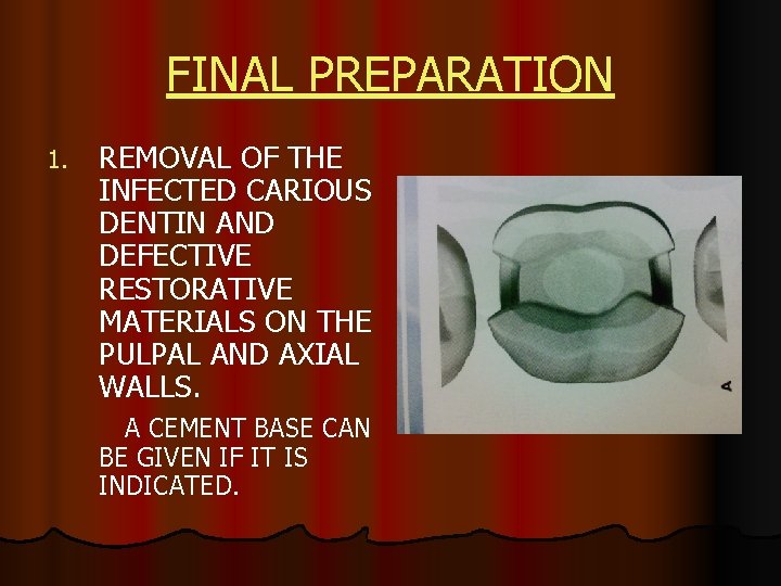 FINAL PREPARATION 1. REMOVAL OF THE INFECTED CARIOUS DENTIN AND DEFECTIVE RESTORATIVE MATERIALS ON