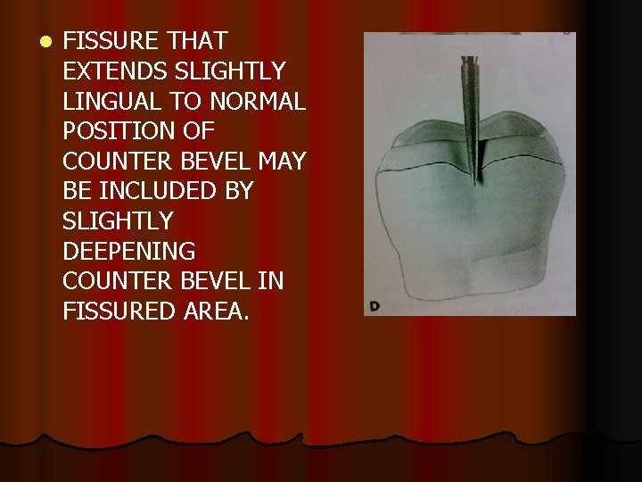 l FISSURE THAT EXTENDS SLIGHTLY LINGUAL TO NORMAL POSITION OF COUNTER BEVEL MAY BE