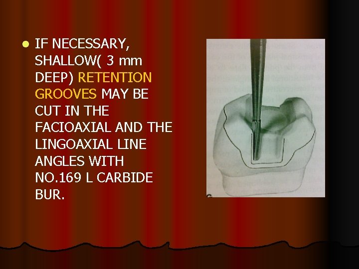 l IF NECESSARY, SHALLOW( 3 mm DEEP) RETENTION GROOVES MAY BE CUT IN THE