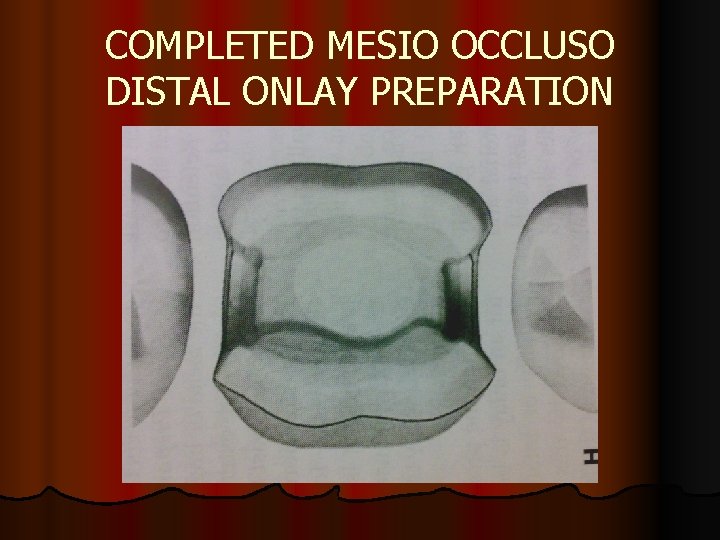 COMPLETED MESIO OCCLUSO DISTAL ONLAY PREPARATION 