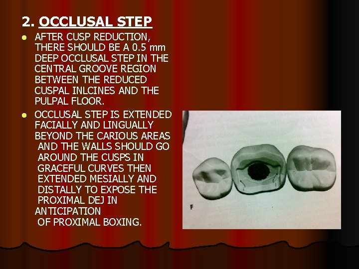 2. OCCLUSAL STEP AFTER CUSP REDUCTION, THERE SHOULD BE A 0. 5 mm DEEP