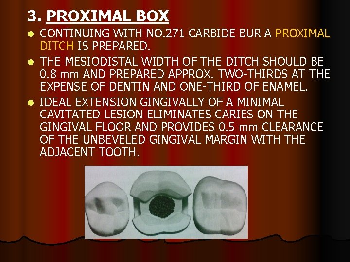 3. PROXIMAL BOX CONTINUING WITH NO. 271 CARBIDE BUR A PROXIMAL DITCH IS PREPARED.