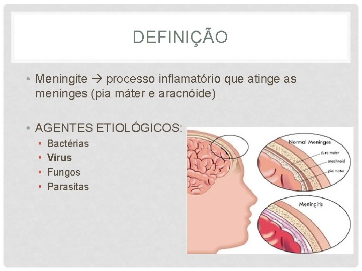 DEFINIÇÃO • Meningite processo inflamatório que atinge as meninges (pia máter e aracnóide) •