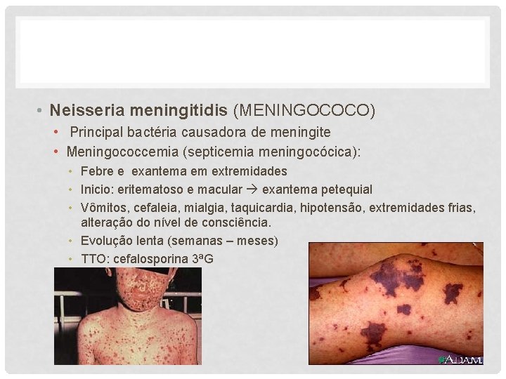  • Neisseria meningitidis (MENINGOCOCO) • Principal bactéria causadora de meningite • Meningococcemia (septicemia