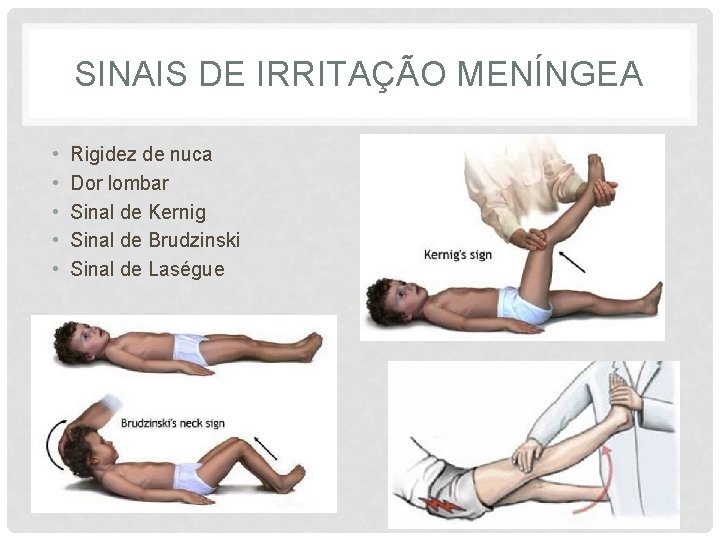 SINAIS DE IRRITAÇÃO MENÍNGEA • • • Rigidez de nuca Dor lombar Sinal de