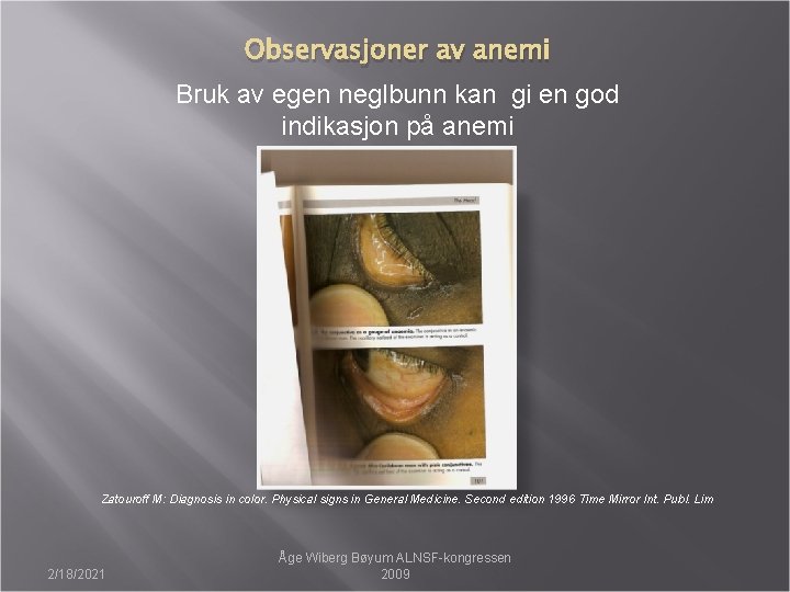 Observasjoner av anemi Bruk av egen neglbunn kan gi en god indikasjon på anemi