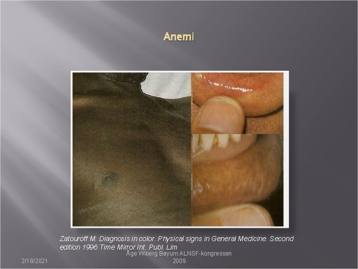 Anemi Zatouroff M: Diagnosis in color. Physical signs in General Medicine. Second edition 1996