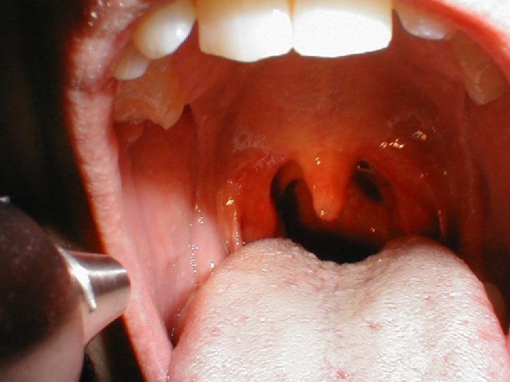 Pharyngitis Presentation 