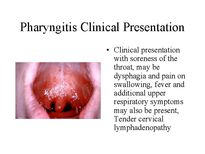 Pharyngitis Clinical Presentation • Clinical presentation with soreness of the throat, may be dysphagia