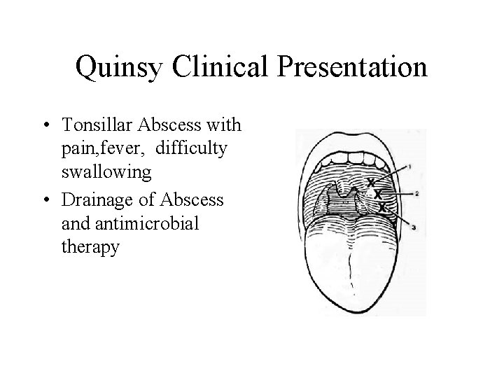 Quinsy Clinical Presentation • Tonsillar Abscess with pain, fever, difficulty swallowing • Drainage of