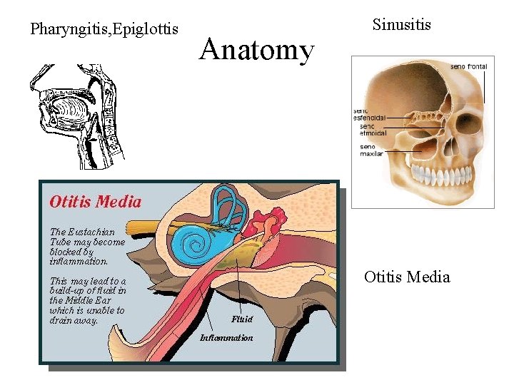 Pharyngitis, Epiglottis Anatomy Sinusitis Otitis Media 