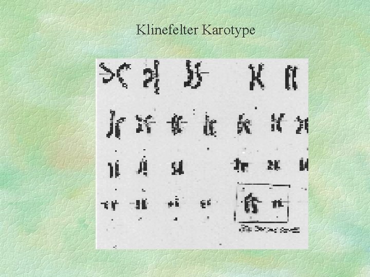 Klinefelter Karotype 