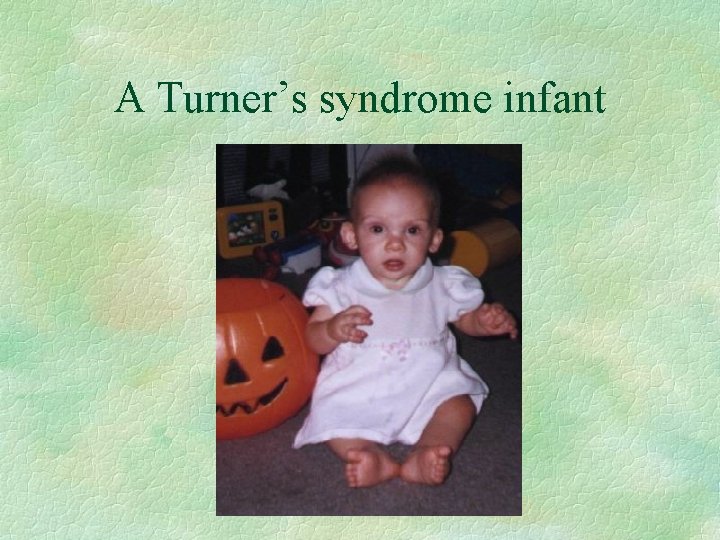 A Turner’s syndrome infant 