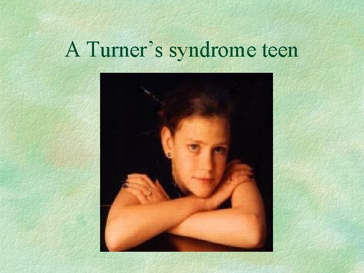 A Turner’s syndrome teen 