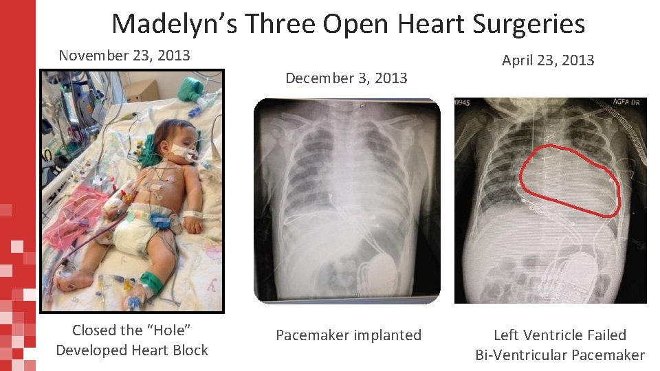 Madelyn’s Three Open Heart Surgeries November 23, 2013 December 3, 2013 Closed the “Hole”