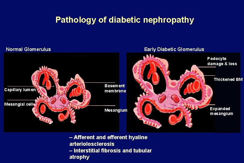Pathology of diabetic nephropathy Normal Glomerulus Early Diabetic Glomerulus Podocyte damage & loss Thickened
