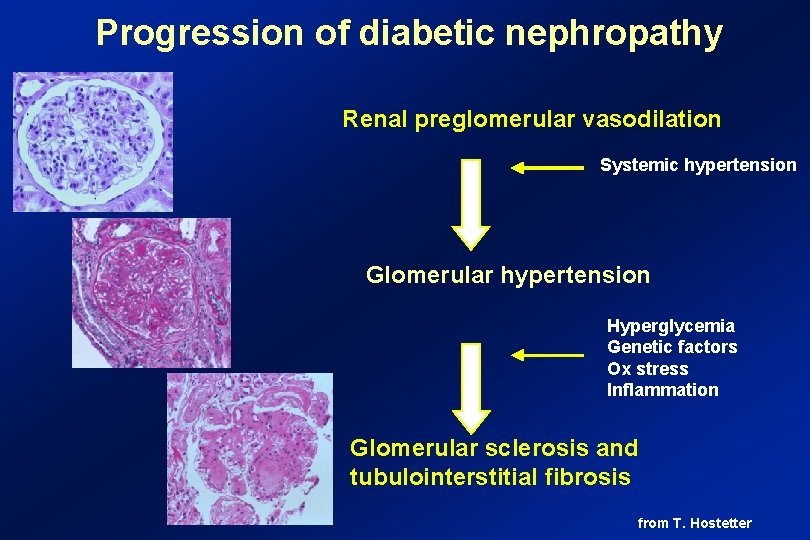 Progression of diabetic nephropathy Renal preglomerular vasodilation Systemic hypertension Glomerular hypertension Hyperglycemia Genetic factors