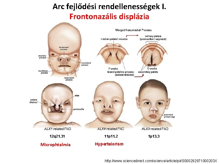 Arc fejlődési rendellenességek I. Frontonazális displázia 12 q 21. 31 Microphtalmia 11 p 11.