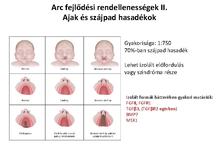 Arc fejlődési rendellenességek II. Ajak és szájpad hasadékok Gyakorisága: 1: 750 70%-ban szájpad hasadék