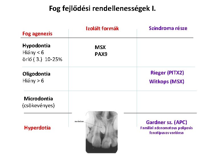 Fog fejlődési rendellenességek I. Fog agenezis Hypodontia Hiány < 6 örlő ( 3. )